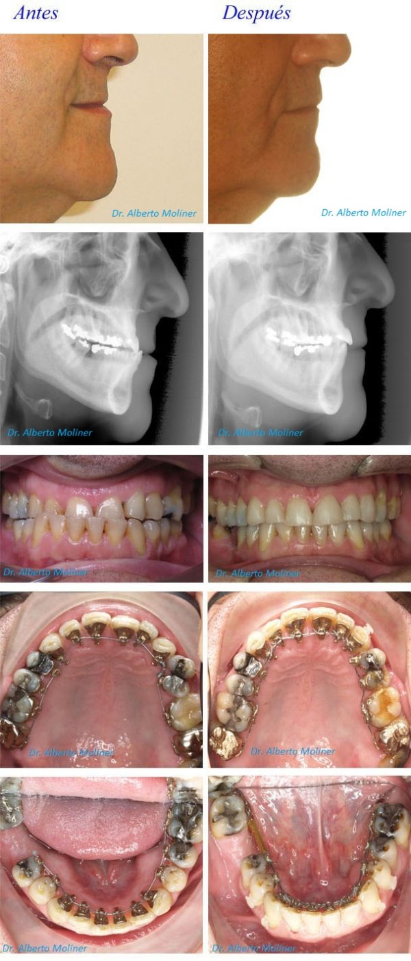 Mordida Cruzada Caso Resuelto Con Lingual Ortodoncia Invisible